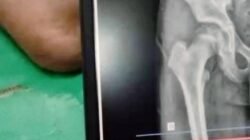 Tulang Panggul Retak, Siswa SMP Swasta di Nagrak Diduga Jadi Korban Perundungan