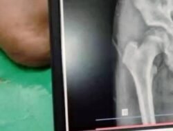 Tulang Panggul Retak, Siswa SMP Swasta di Nagrak Diduga Jadi Korban Perundungan